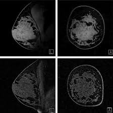 MRI Mammography and Spectroscopy