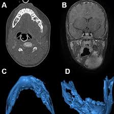 MRI Mandible