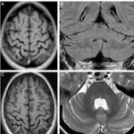MRI Of Affected Area