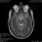 MRI Orbit With Contrast
