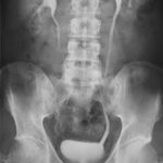 MRI Pyelogram