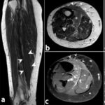 MRI Right Calf Region