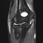 MRI Right Elbow Joint