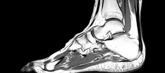 MRI Right Foot with Leg