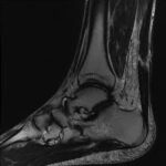 MRI Right Heel With Contrast