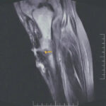MRI Right Leg