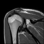 MRI Right Shoulder
