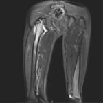 MRI Right Thigh