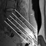MRI Sacrum Coccyx Joint