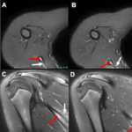 MRI Scapula Test