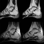 MRI Screening Right Foot Joint