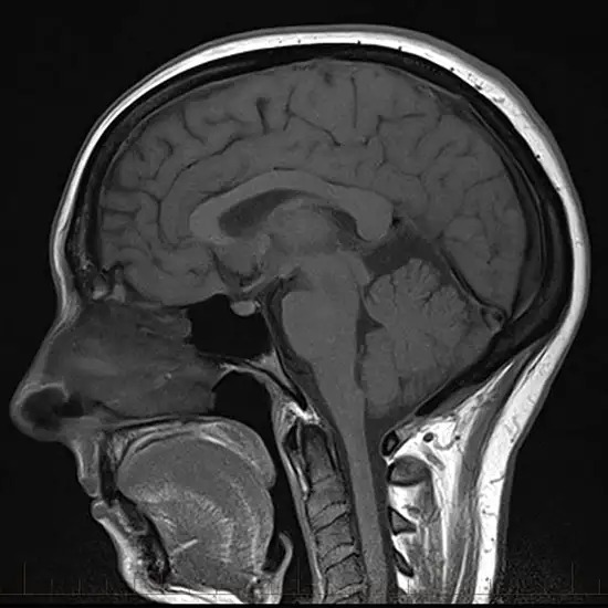 MRI Screening of Brain Cervical ROI