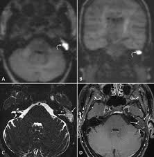MRI Screening of Ear