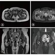MRI Screening of Gluteal Region