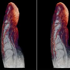 MRI Screening of Middle Finger