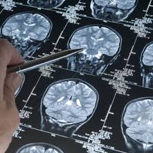 MRI TIA Protocol