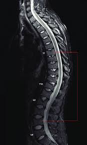 MRI Thoracic Lumbar Spine