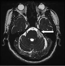 MRI Trigeminal Neuralgia Protocol