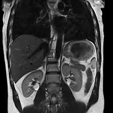 MRI Whole Abdomen