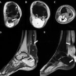 MRI of the Left Ankle With a Cartigram