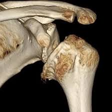 NCCT 3D Left Shoulder