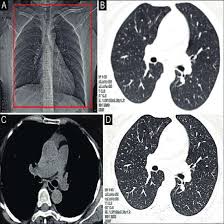 NCCT Chest Scan