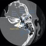 NCCT Head With Temporal Bone