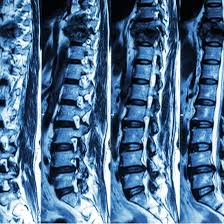 NCCT LS Spine