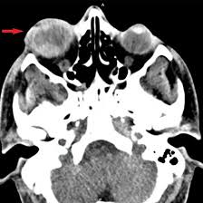 NCCT Scan Orbit Axial