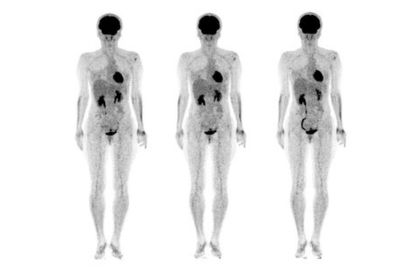 Whole body PET CT