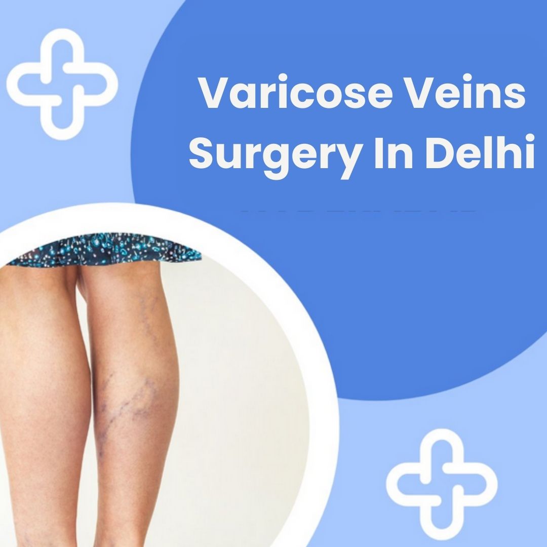 Varicose Veins Surgery in Delhi
