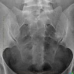 X-RAY SI Joint AP View
