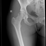 X-Ray Bilateral Femur AP View
