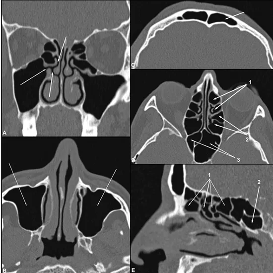 ct pns scan
