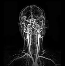 MR Angiography Carotid Vessels