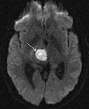 MRI Brain With Diffusion