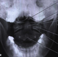 X-Ray Cervical Spine Open Mouth View