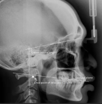 Tm Ray X-ray TM Joint (MC)