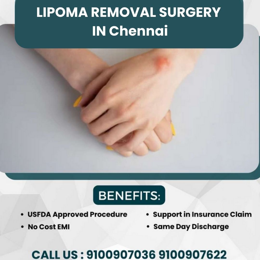 LIPOMA REMOVAL SURGERY IN Chennai