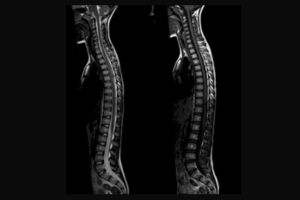 MRI Whole Spine