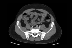Ct scan Pelvis