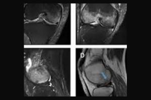 MRI Both Knee Joint