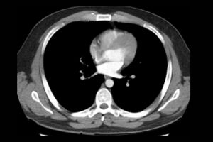 Ct Scan Chest
