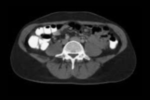 Ct scan Abdomen