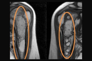 MRI Both Shoulder Joints