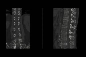 Ct scan spine