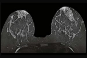 MRI Breast