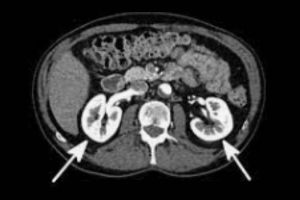 Ct scan kub