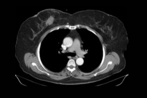 CT Scan Breast