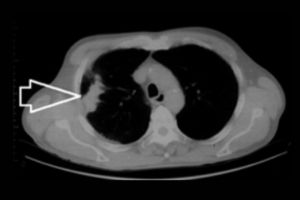 Ct scan Thorax